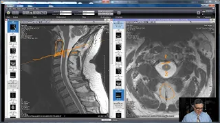 How To Read Your Cervical MRI (Part 2 of 2): Let's Go Over My Cervical MRI Disk With Onis 2.5.