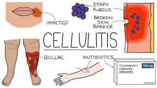 Cellulitis | Skin and Soft Tissue Infections | Drk