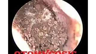 Severe fungal infection - Otomycosis ear cleaning