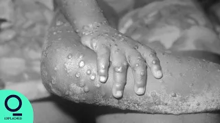 5 Things to Know About Monkeypox