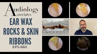 EAR WAX ROCKS & SKIN RIBBONS - EP660