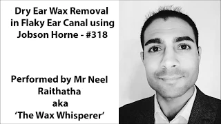 Dry Ear Wax Removal in Flaky Ear Canal using Jobson Horne - #318