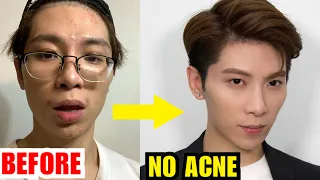How : Get Rid of ACNE ? | NO medicine +  Natural Way Goodbye ACNE FACE 告別暗瘡粉刺 | ISSAC YIU