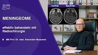 Meningeome effektiv behandeln: Radiochirurgie als Behandlungsalternative ohne OP