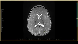 Brain Trauma - Non-accidental Trauma, Glutamate Expression