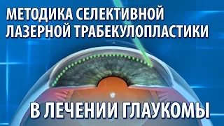 Методика селективной лазерной  в лечении глаукомы