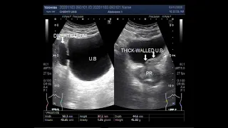 Ultrasound Video showing Vesical Diverticulum, Cystitis, BPH, Cholelithiasis, and small renal stone.