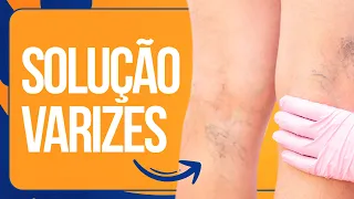 🌟 VARIZES NUNCA MAIS: Exercícios e Dicas Valiosas! Aurélio Alfieri