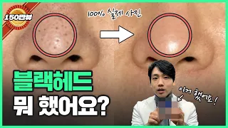 피부과 안가고 블랙헤드 없애기 | 홈케어 블랙헤드 제거 방법