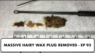 MASSIVE HAIRY PLUG OF EAR WAX REMOVED - EP 93