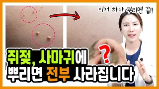 OO만 뿌리면 쥐젖, 사마귀 뚝 떨어진다고? 현직의사 10년을 갈아넣은 쥐젖, 편평사마귀 없애는 방법! 꿀팁! 노하우!