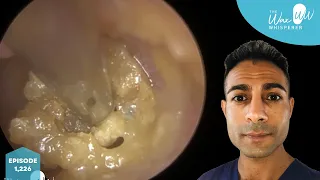 1,226 - Complex & Challenging Ear Wax Removal