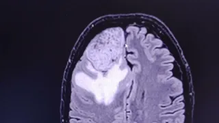 Aggressive meningioma - CT venogram and MRI