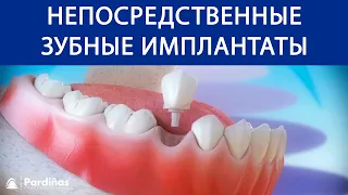 Непосредственные зубные имплантаты после удаление зуба ©