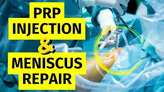 PRP Injection for Meniscus Tear Repair