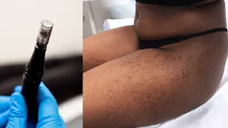 Stretch Mark Removal with Microneedling