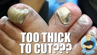 TRIMMING EXTREMELY THICK TOENAILS - FULL TREATMENT