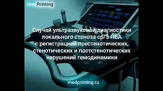 Атеросклероз, локальный стеноз ПБА 75-90% с нарушениями гемодинамики