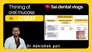 THINNING OF MUCOSA IN OSMF