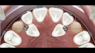 Orthodontic case report for palatally impacted canines traction