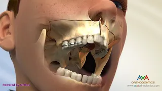 Surgical Orthodontic Treatment for Constricted Upper Jaw - SARPE