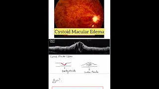 Central Retinal Vein Occlusion - Case Discussion In A Minute #Shorts