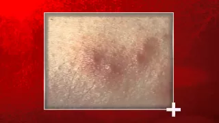 Signs of Bed Bug Bites - Health Checks