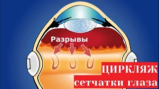 Циркляж сетчатки глаза с пломбированием - операция при разрыве и отслойке и её осложнения