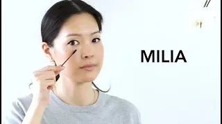Milia - How to Treat & Prevent | Best Eye Products