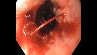 Esophageal Variceal Hemorrhage