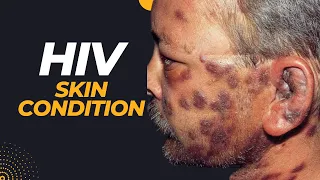 HIV and Skin condition