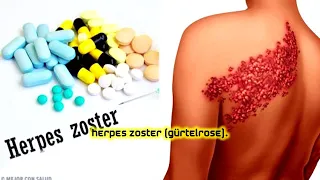 Herpes Zoster (Gürtelrose)