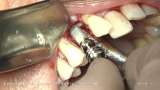 IMPLANTOLOGY - REX CASE REPORT - Implant positioned in 4 mm crestal bone width - Tomaso Vercellotti