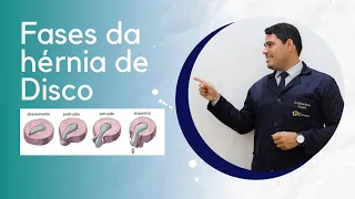 Fases da Hérnia de Disco