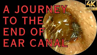 A JOURNEY TO THE END OF EAR CANAL (4K 60FPS)