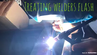 home remedy treatment for welders flash