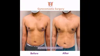 Gynecomastia Result - Before & After - Morning to Evening Transformation Male Breast Surgery Gurgaon