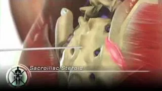 Sacroilliac Joint Steroid Injection
