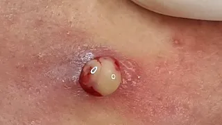 Pimple Popping // Cyst Removal // Blackhead Removal // TE#024 (Oddly Satisfy) // Music Relax