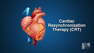 Ventricular Fibrillation Treatment: Cardiac Resyncrhoniation Therapy (CRT)