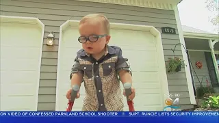 Two-Year-Old Overcomes The Odds And Learns To Walk