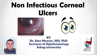 Non Infectious Corneal Ulcers