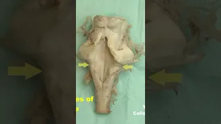 Rhomboid fossa human brainstem #neuroanatomy #brainstem #rhomboid fossa #anatomy