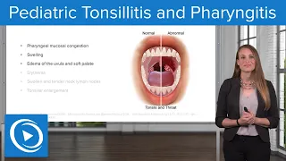 Pediatric Tonsillitis and Pharyngitis – Pediatric Nursing | Lecturio