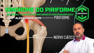 Síndrome do Piriforme - Definição, Incidência e Tratamento Fisioterapêutico