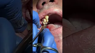 Операция имплантации с синус-лифтингом