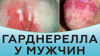 Гарднерелла у мужчин