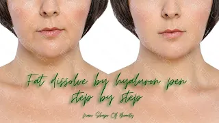 Fat dissolve by hyaluron pen step by step