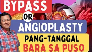 Bypass Or Angioplasty: Pang-tanggal ng Bara sa Puso. -By Doc Willie Ong (Internist and Cardiologist)