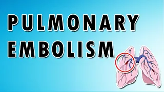 Clots on the Move: A Deep Dive into Pulmonary Embolism Dynamics